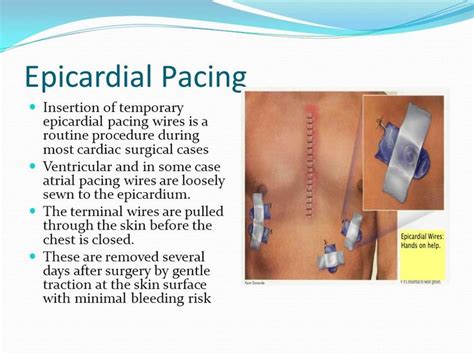 ventricular epicardial lead.